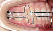 retainer for orthodontic treatment