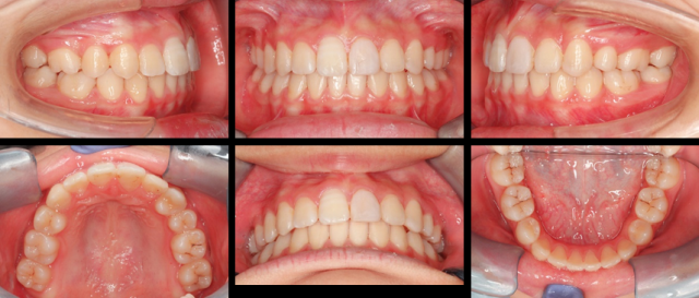 post-treatment_teeth.png